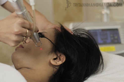 Cách điều trị tàn nhang bằng công nghệ Laser