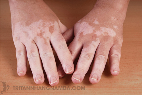 Rối loạn sắc tố da ở tay là gì?