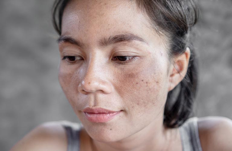 Nám da là một rối loạn sắc tố da phổ biến ở phụ nữ Việt